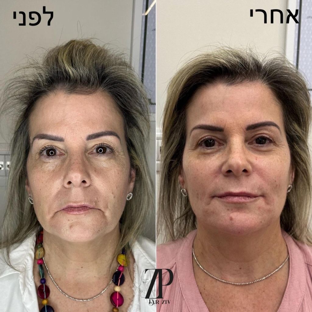 עיצוב עצמות לחיים - לפני ואחרי