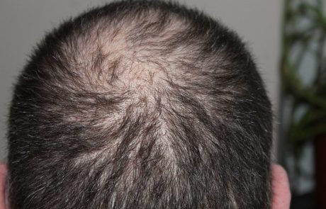 טיפול PRP בנשירת שיער – הסוף להתקרחות במרכזי דוקטור חן בפריסה ארצית