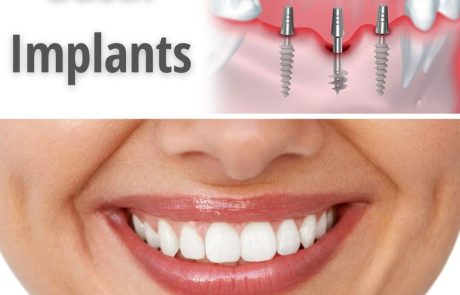  השתלת שיניים למחוסרי עצם: כל הדרכים והאלטרנטיבות החדשניות