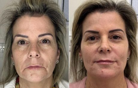 מילוי לחיים או פיסול פנים: ההבדל הקריטי שישיג לך את המראה הנכון