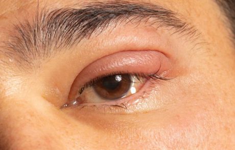 דלקות עיניים – הגורמים להן ואפשרויות הטיפול