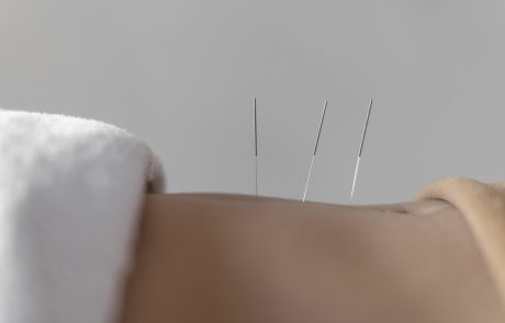 בלי כאב ובלי מבוכה: איך דיקור סיני משחרר כאבים בפי הטבעת ומחזיר את איכות החיים?