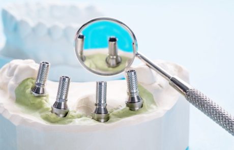 כמה זמן מחזיק שתל שיניים? מה באמת משפיע על אורך החיים שלו