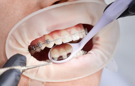 המדריך המקיף ליישור שיניים במבוגרים ומה שאתה צריך לדעת