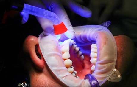 אילו טיפולי שיניים ניתן לעשות עם לייזר