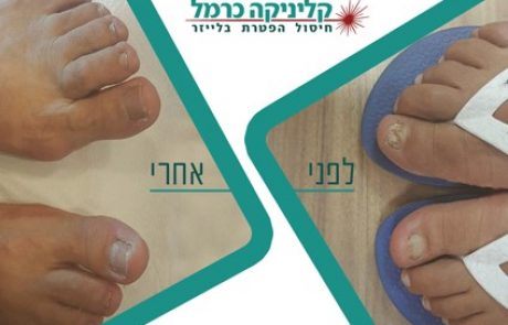 זה קורה לכולם: לא תאמינו לאיזו זמרת בינלאומית יש פטרת ציפורניים