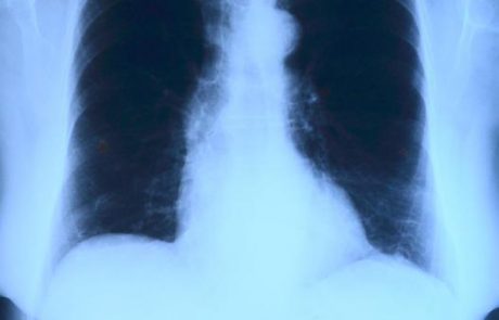 תוצאות חיוביות בניסוי קליני ראשון בבני אדם לטיפול בתסחיף ריאתי (PE)