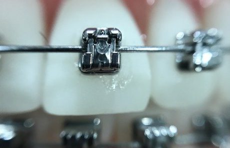 פעם אחת ולתמיד – כמה זמן שמים גשר בשיניים?
