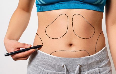 שאיבת שומן ללא ניתוח – האם זה מסוכן?
